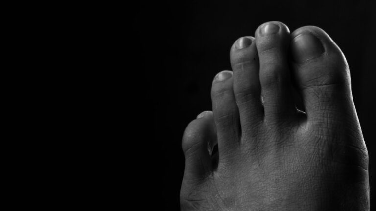 Illustration d’un hallux valgus : vue du pied avec déviation de l’orteil et dispositifs de traitement naturel, à associer à un avis médical